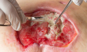 Debridement-2